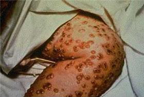 Typhus 3.jpg