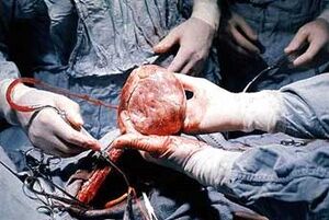 Transplantacia.jpg
