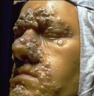 Wax anatomical madel syphilis.jpg